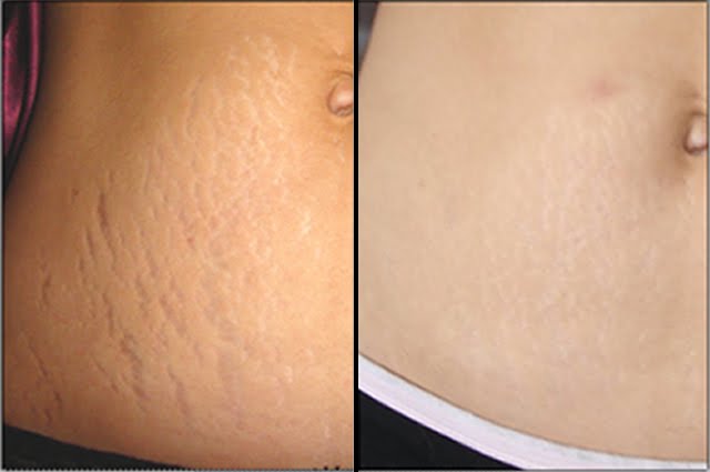 Dermaroller Estrias Antes e Depois