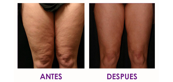 resultados mesoterapia