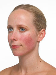 Mulher com vermelhidão facial